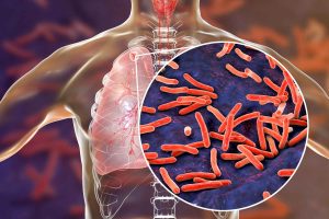 What-is-tuberculosis