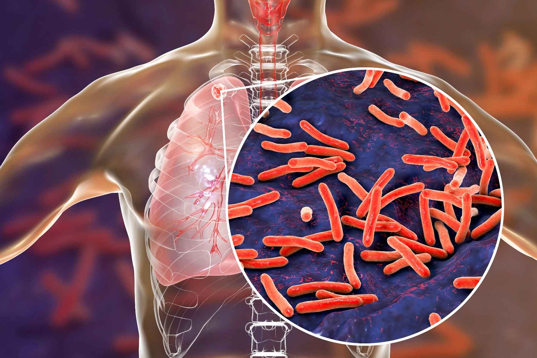 What-is-tuberculosis